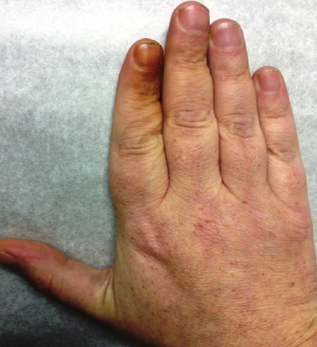 A Man With Yellowish Nail Discoloration Consultant360